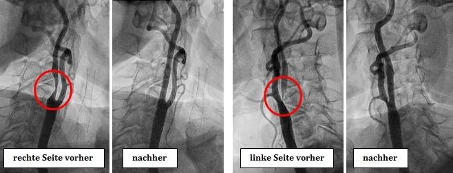 Hochgradige Symptomatische Stenose 