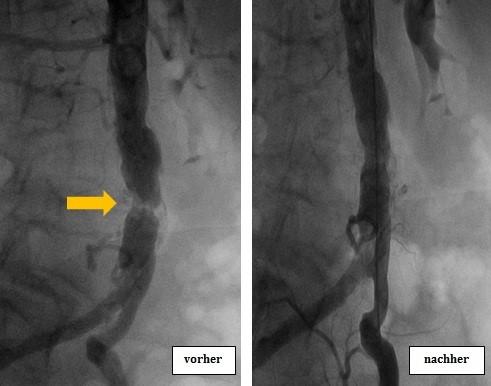 78-jährige Patientin mit hochgradiger Stenose der infrarenalen Bauchaorta (links; Pfeil), die erfolgreich mittels Ballondilatation und Stenting behandelt werden konnte (rechts). 