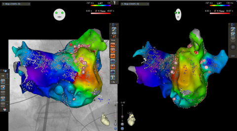 Atypisches Vorhofflattern im 3-D-Mapping