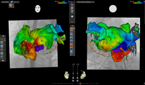 Fokale atriale Tachykardie im 3D-Mapping