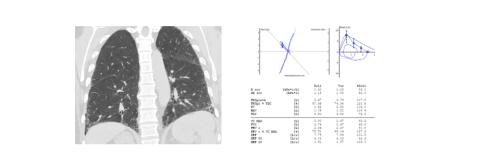 HR-CT Lunge