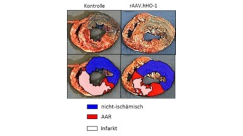 infartgrosse_nach_revaskularisierung_und_protektiver_therapie